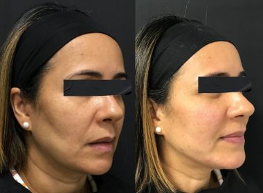 Harmonização Facial Premium