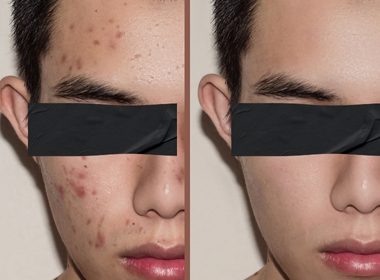 Protocolo Acne Zero - Revolução no Tratamento