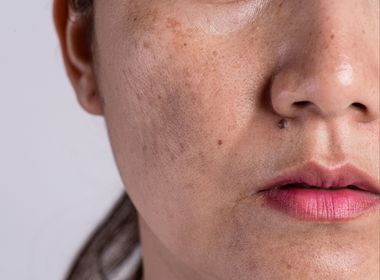 Tratamento Melasma Definitivo